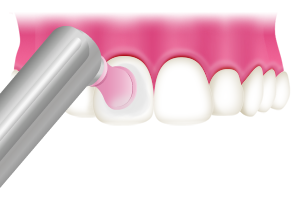歯の表面をツルツルに