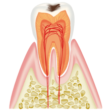 C1（エナメル質の虫歯）