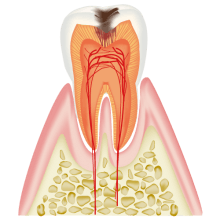 C2（象牙質の虫歯）