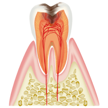 C3（神経の虫歯）