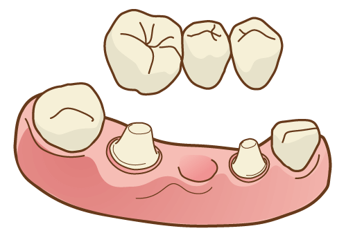 ブリッジ治療