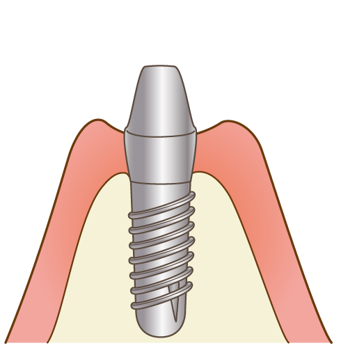 インプラント体が骨と結合した後、2次手術（2回法の場合）
