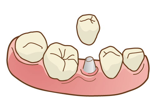インプラントの場合