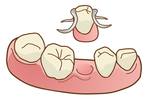 入れ歯の場合