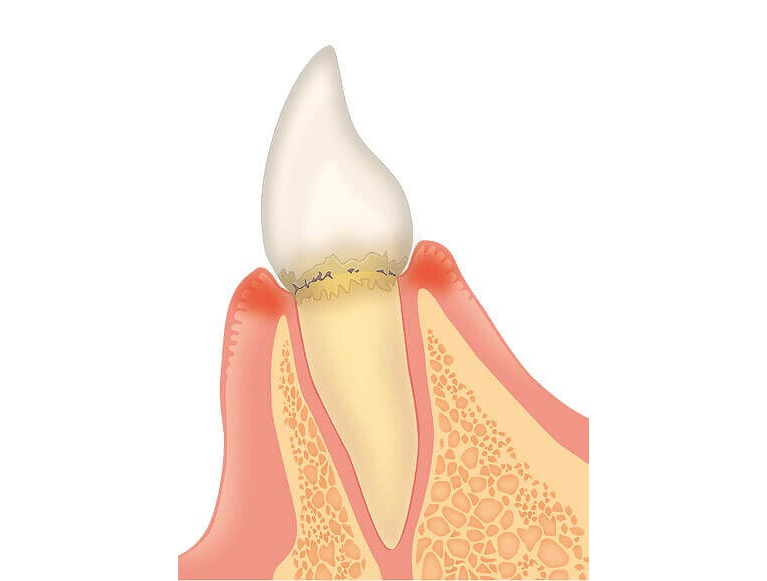 歯肉炎（歯周ポケットの深さ：3mm以内）