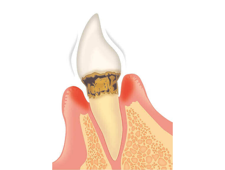 中等度歯周炎（歯周ポケットの深さ：5～7mm程度）