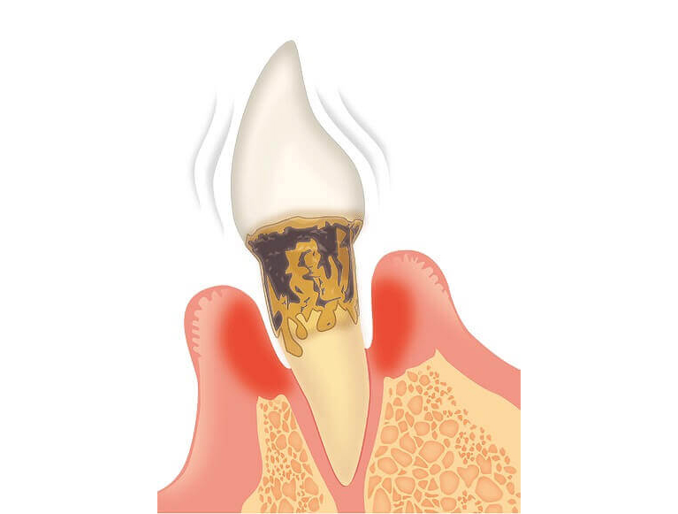 重度歯周炎（歯周ポケットの深さ：7mm以上）