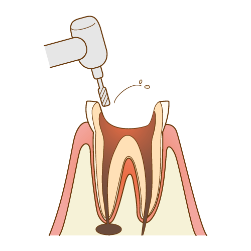 麻酔を行い、歯の神経を取る