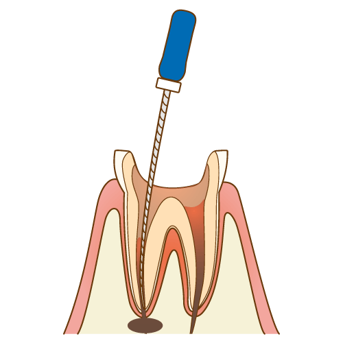 歯の神経が入っていた管（根管・こんかん）をキレイにする