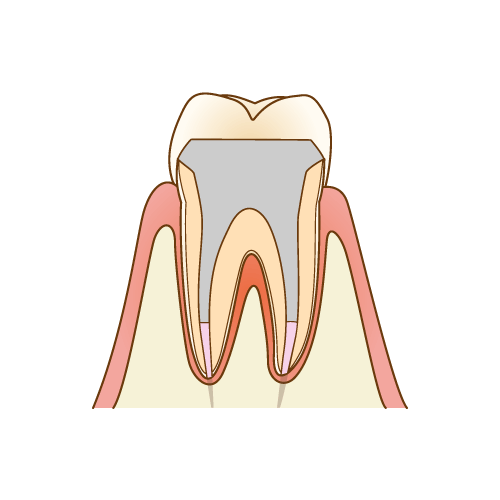 かぶせ物・詰め物の治療
