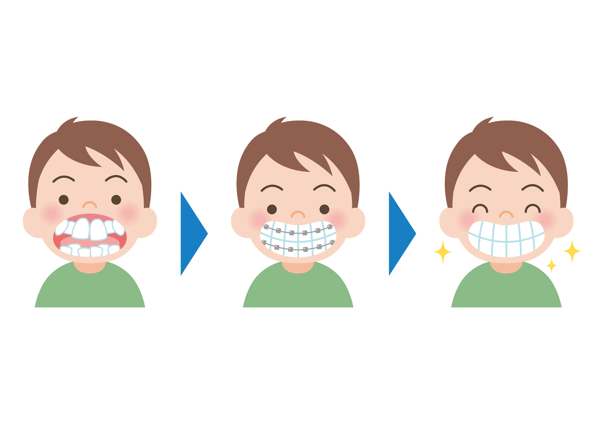 子どもの出っ歯（上顎前突）の治療について