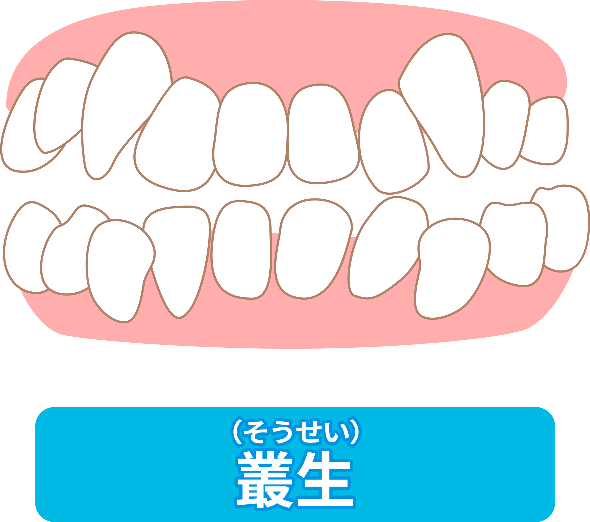 叢生（でこぼこ）とは